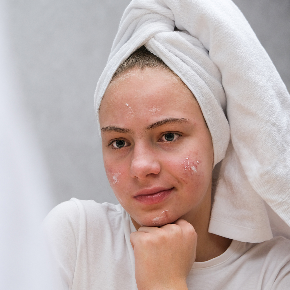 Acneea la adolescenți: cauze și îngrijire